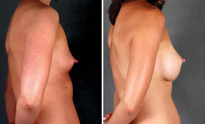 Breast Augmentation Before and After Photos in Omaha, NE, Case 4581