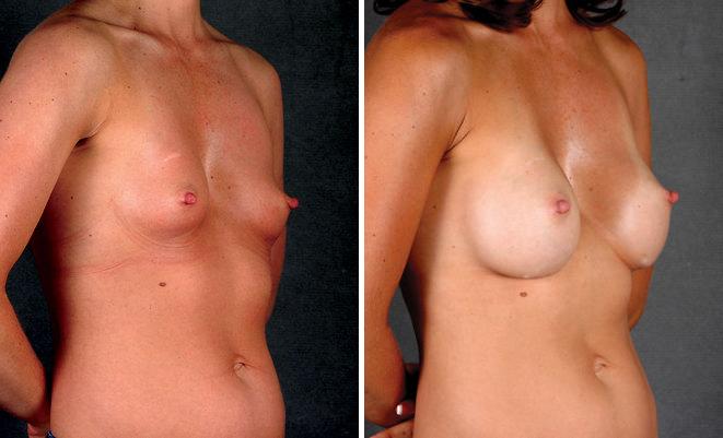 Breast Augmentation Before and After Photos in Omaha, NE, Case 4581