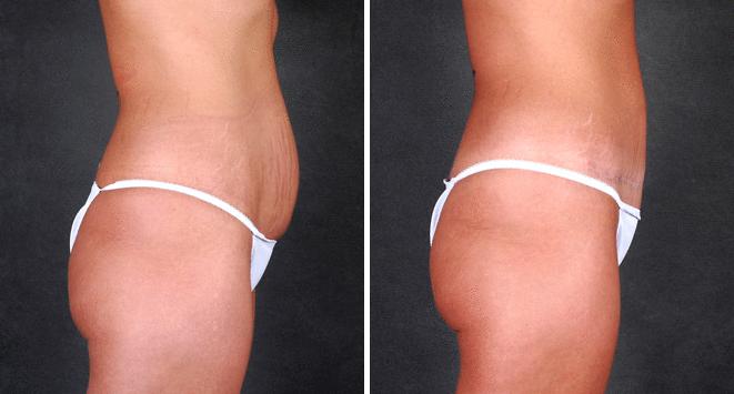 Case 4719, Breast Augmentation Before and After Photos Breast Augmentation Before and After Photos in Omaha, NE, Case 4719