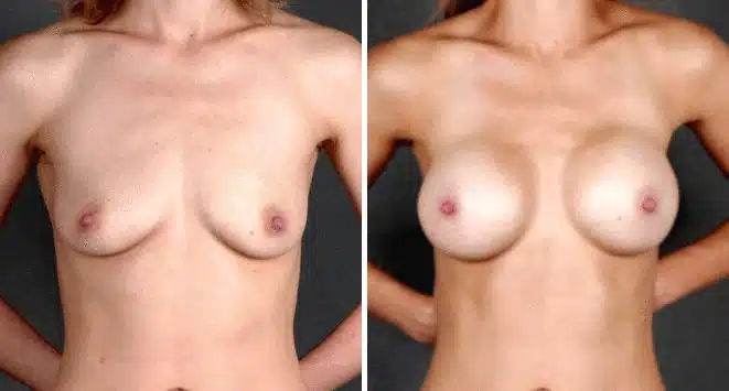 Breast Augmentation Before and After Photos in Omaha, NE, Case 4743