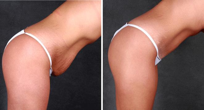Case 4719, Breast Augmentation Before and After Photos Breast Augmentation Before and After Photos in Omaha, NE, Case 4719