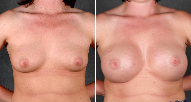 Breast Augmentation Before and After Photos in Omaha, NE, Case 4764