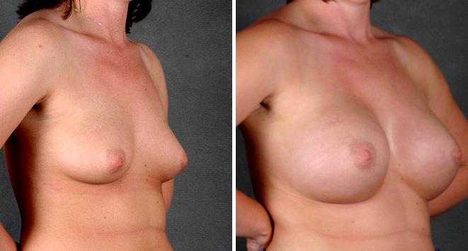 Breast Augmentation Before and After Photos in Omaha, NE, Case 4764