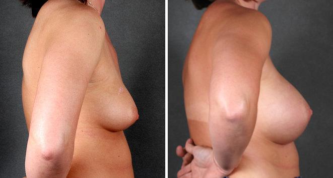 Breast Augmentation Before and After Photos in Omaha, NE, Case 4764