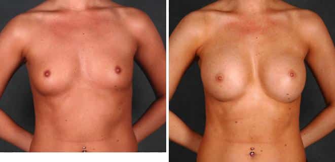 Breast Augmentation Before and After Photos in Omaha, NE, Case 4780