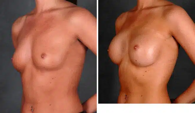 Breast Augmentation Before and After Photos in Omaha, NE, Case 4780