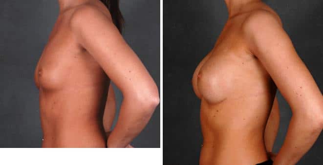 Breast Augmentation Before and After Photos in Omaha, NE, Case 4780