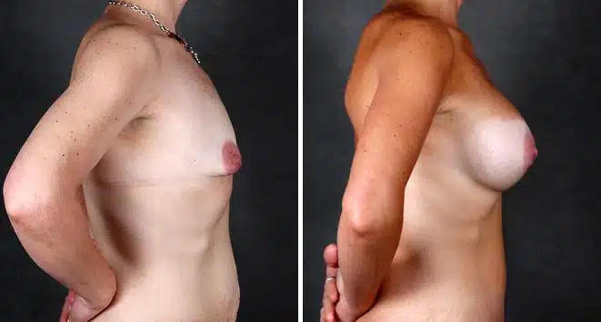 Breast Augmentation Before and After Photos in Omaha, NE, Case 4805