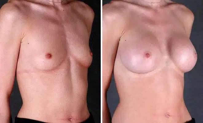 Breast Augmentation Before and After Photos in Omaha, NE, Case 4849