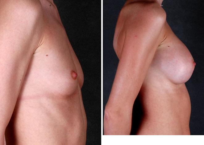 Breast Augmentation Before and After Photos in Omaha, NE, Case 4849