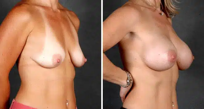 Breast Augmentation Before and After Photos in Omaha, NE, Case 4873