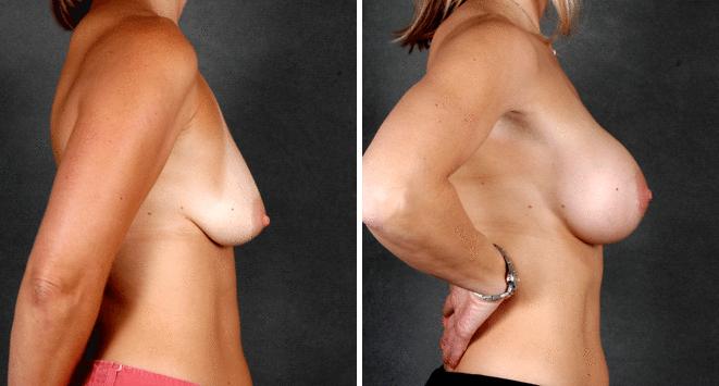 Breast Augmentation Before and After Photos in Omaha, NE, Case 4873