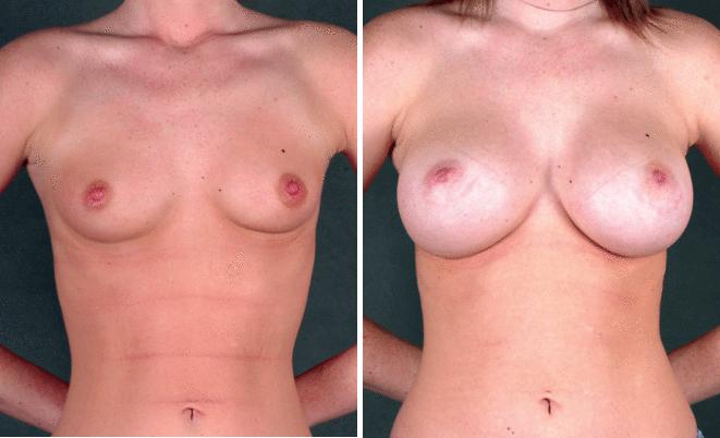 Breast Augmentation Before and After Photos in Omaha, NE, Case 4898