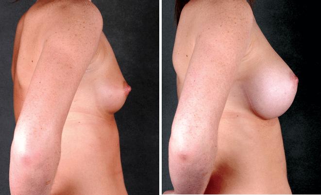 Breast Augmentation Before and After Photos in Omaha, NE, Case 4898