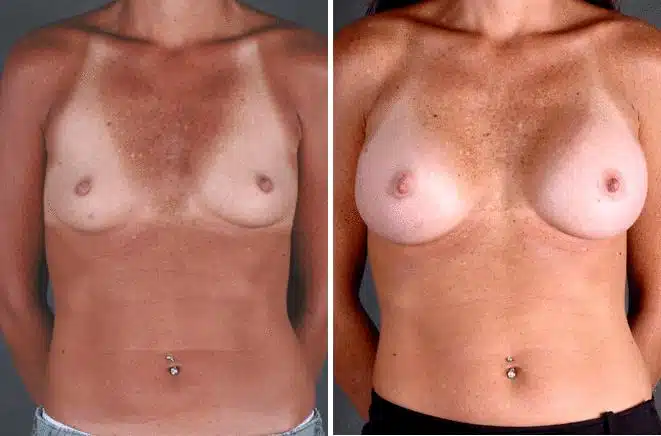 Breast Augmentation Before and After Photos in Omaha, NE, Case 4904