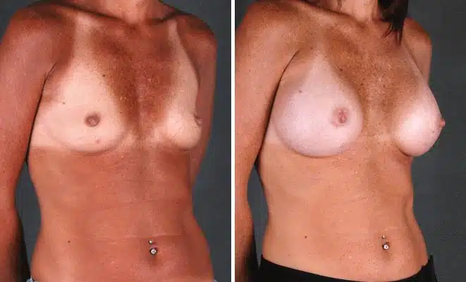 Breast Augmentation Before and After Photos in Omaha, NE, Case 4904