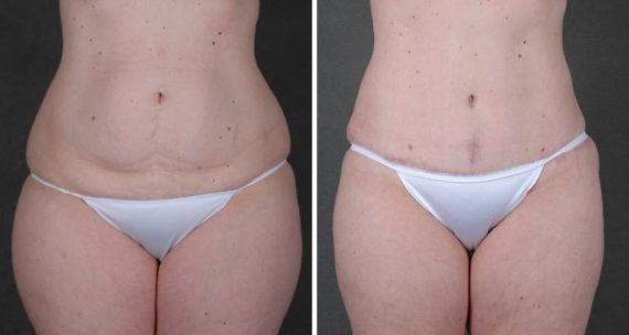 Tummy Tuck Before and After Photos in Omaha, NE, Case 4832