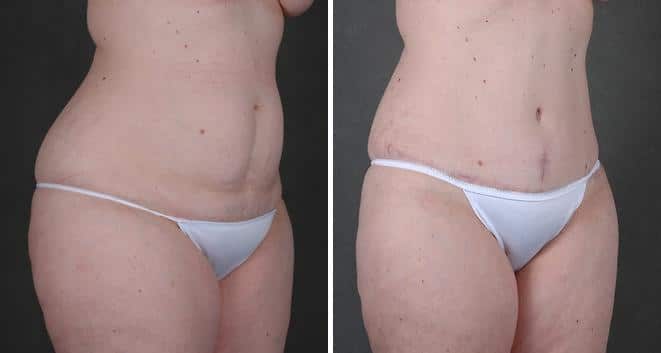 Tummy Tuck Before and After Photos in Omaha, NE, Case 4832