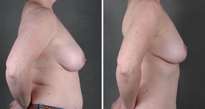 Case 4832, Tummy Tuck Before and After Photos Tummy Tuck Before and After Photos in Omaha, NE, Case 4832