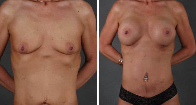 Tummy Tuck Before and After Photos in Omaha, NE, Case 4847