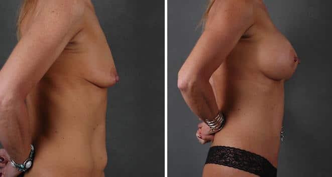 Tummy Tuck Before and After Photos in Omaha, NE, Case 4847