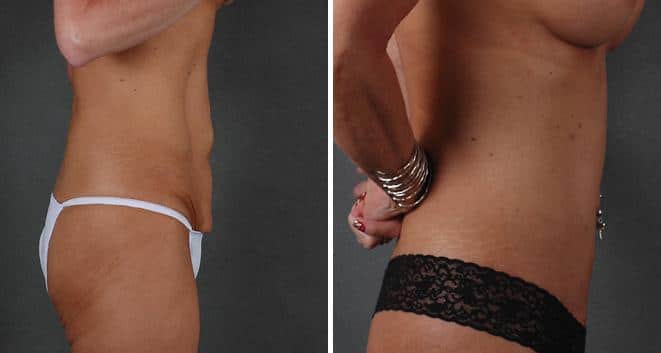 Tummy Tuck Before and After Photos in Omaha, NE, Case 4847