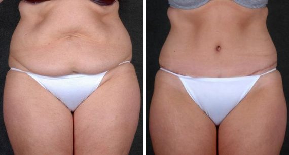 Tummy Tuck Before and After Photos in Omaha, NE, Case 4848