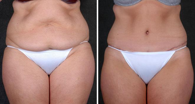 Case 4848, Tummy Tuck Before and After Photos Tummy Tuck Before and After Photos in Omaha, NE, Case 4848