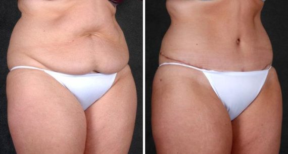 Tummy Tuck Before and After Photos in Omaha, NE, Case 4848