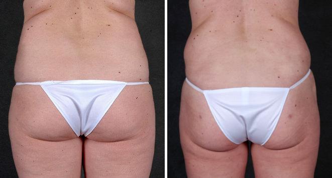 Case 4857, Tummy Tuck Before and After Photos Tummy Tuck Before and After Photos in Omaha, NE, Case 4857