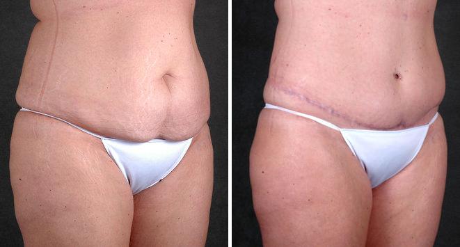 Case 4858, Tummy Tuck Before and After Photos Tummy Tuck Before and After Photos in Omaha, NE, Case 4858