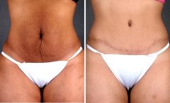 Tummy Tuck Before and After Photos in Omaha, NE, Case 4859