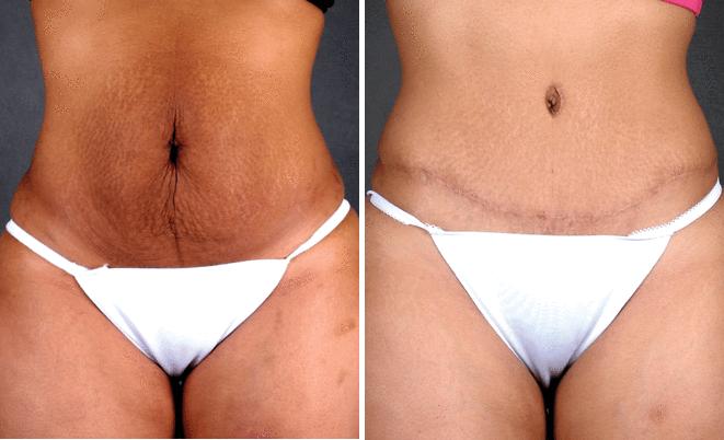 Tummy Tuck Before and After Photos in Omaha, NE, Case 4859