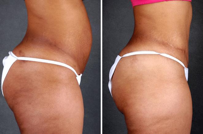Tummy Tuck Before and After Photos in Omaha, NE, Case 4859