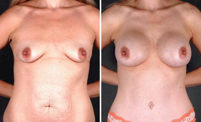 Tummy Tuck Before and After Photos in Omaha, NE, Case 4864