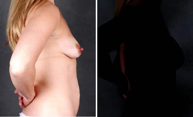 Tummy Tuck Before and After Photos in Omaha, NE, Case 4864