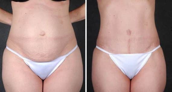 Tummy Tuck Before and After Photos in Omaha, NE, Case 4824