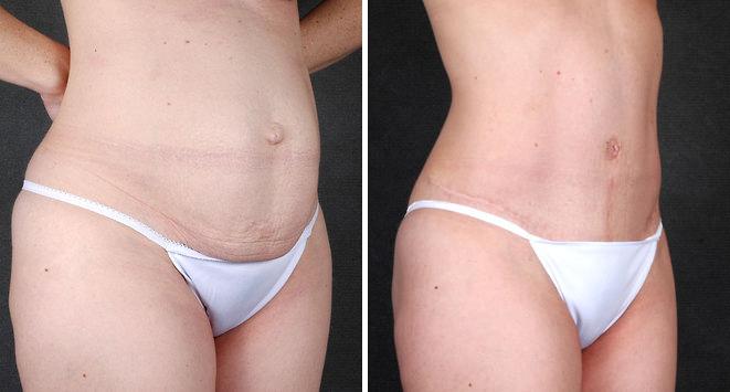 Tummy Tuck Before and After Photos in Omaha, NE, Case 4824