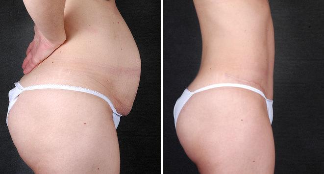 Tummy Tuck Before and After Photos in Omaha, NE, Case 4824