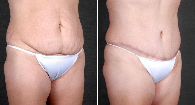 Tummy Tuck Before and After Photos in Omaha, NE, Case 4865