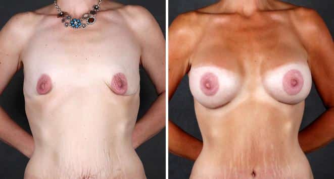 Tummy Tuck Before and After Photos in Omaha, NE, Case 4899