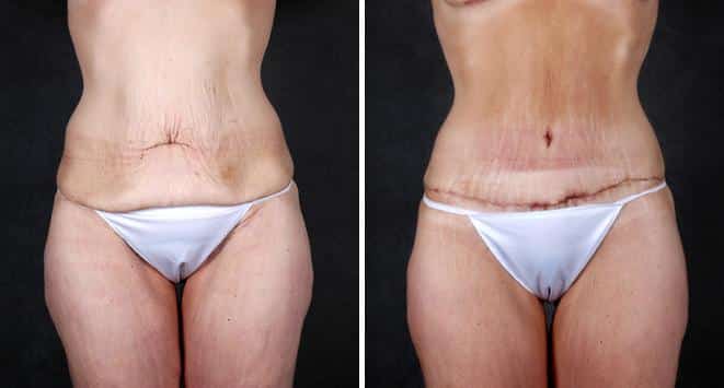 Tummy Tuck Before and After Photos in Omaha, NE, Case 4899