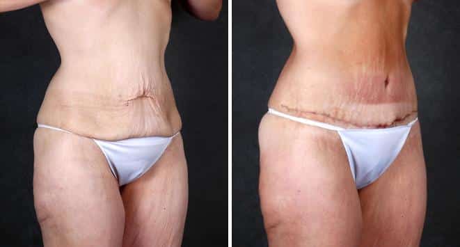 Tummy Tuck Before and After Photos in Omaha, NE, Case 4899