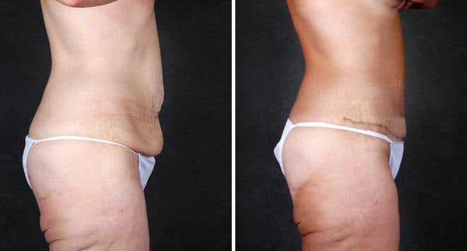 Tummy Tuck Before and After Photos in Omaha, NE, Case 4899