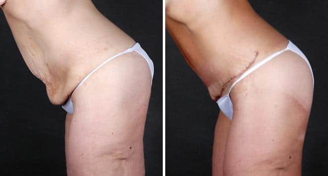 Tummy Tuck Before and After Photos in Omaha, NE, Case 4899