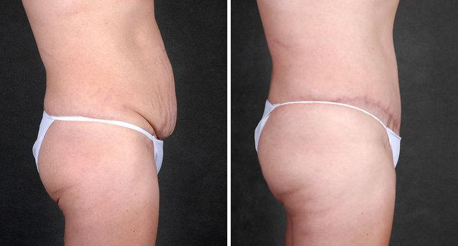 Case 4865, Tummy Tuck Before and After Photos Tummy Tuck Before and After Photos in Omaha, NE, Case 4865