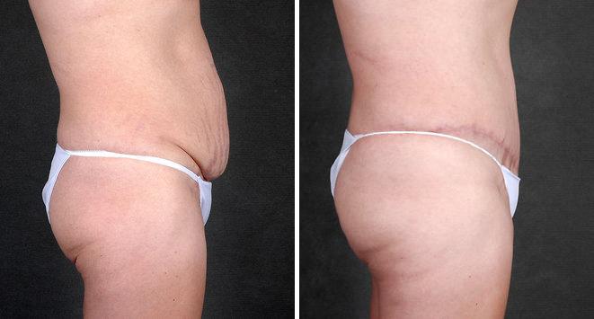 Tummy Tuck Before and After Photos in Omaha, NE, Case 4865