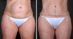 Tummy Tuck Before and After Photos in Omaha, NE, Case 4912