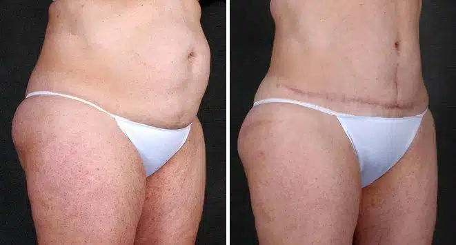 Tummy Tuck Before and After Photos in Omaha, NE, Case 4912