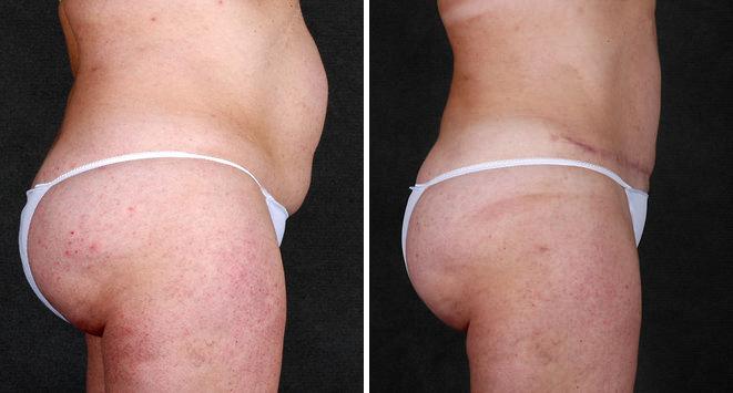 Tummy Tuck Before and After Photos in Omaha, NE, Case 4912